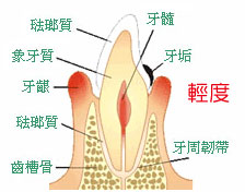 牙周病的發生與預防 牙周病的發生與預防