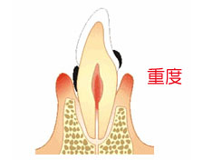 牙周病的發生與預防 牙周病的發生與預防