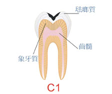 蛀牙和正確刷牙方法