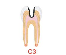 蛀牙和正確刷牙方法