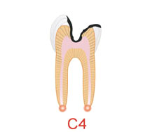 蛀牙和正確刷牙方法